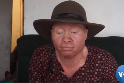 Lazarus Chigwandali with albinism faced a lot of discrimination because of the way his bodies looked.