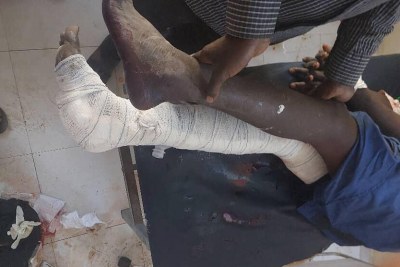 A patient in the MSF supported Nyala Teaching Hospital receives treatment for injuries caused by airstrikes on 3 February 2025.